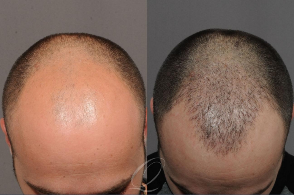 Before and After FUE images