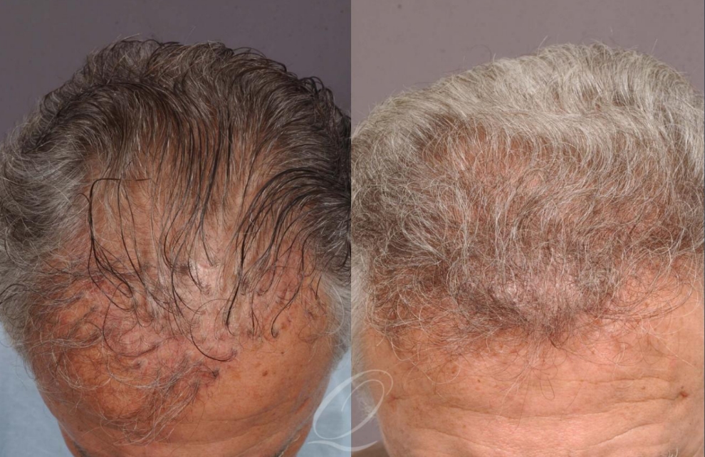 Before and After Hair Plug Repair images