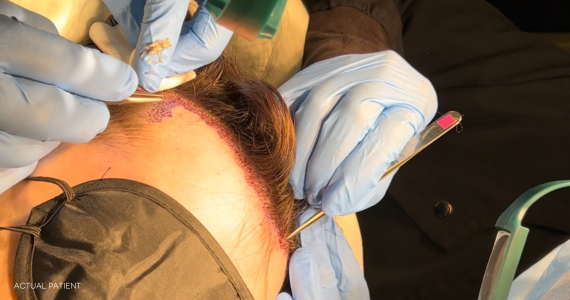 close up of hair transplant, placing grafts in hairline