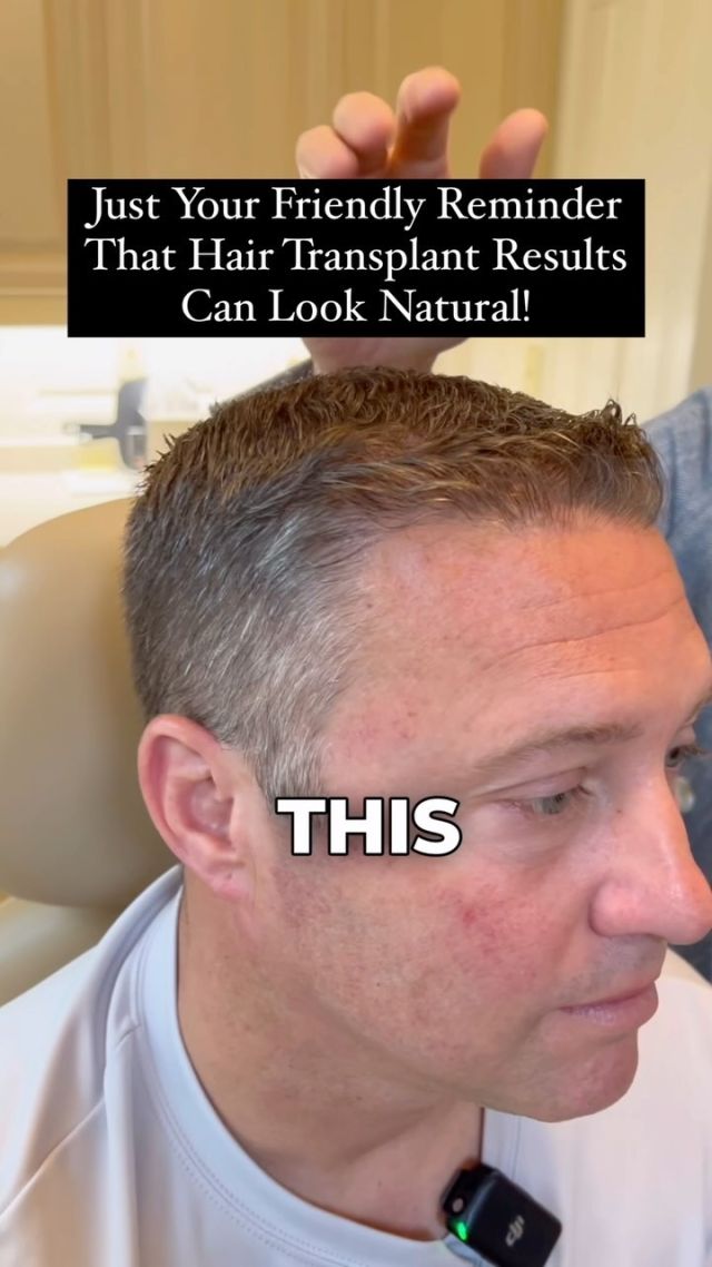 Surgical Technique: FUE/Scarless Method
Grafts: 2,300
Surgeon: @drheatherlee 

You would never look at him and think he had a surgical hair transplant! Natural results are possible!

#hairtransplant #hairtransplantsurgery #hairsurgery #hairloss #hairlosstreatment #hairsurgeon #hairtransplantation #hairtransplantresults #hairtransplantbeforeafter
