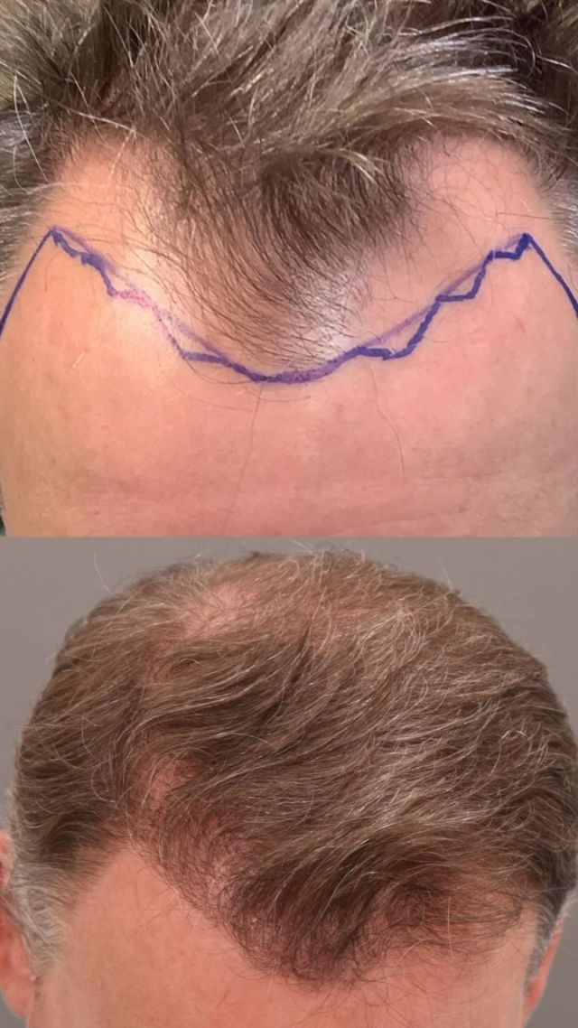 Transplant #1- frontal forelock
Grafts- 1,700
Post-op- 18 months 

Transplant #2- crown
Grafts- 1,700
Post-op- 6 months 

#hairtransplant #hairtransplantation #hairtransplantsurgery #hairsurgery #hairsurgeon #fuehairtransplant