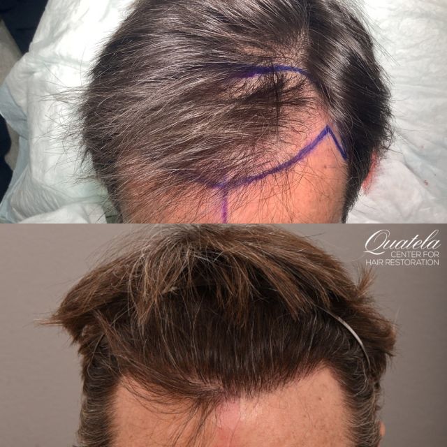 From thin to full! 

This patient from South Carolina was bothered by thinning in his central hairline and along the temporal areas. Dr. Quatela performed a 2,000 graft FUT. He is now one year out from his hair transplant and has a full, dense hairline!

#hairtransplant #hairtransplantation #hairtransplantsurgery #hairsurgery #hairsurgeon #futhairtransplant