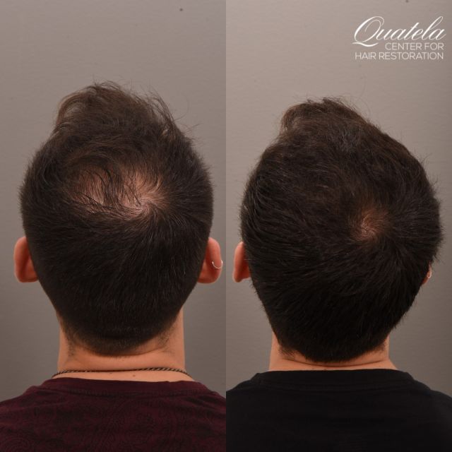 THIS RESULT WAS NON-SURGICAL!!!! THIS is the power of medical management!

This young patient was starting to lose his hair but didn't feel he was at a place to undergo surgery. @dralexmontague put him on a regimen of 82F and Oral Minoxidil just one year ago and he has seen tremendous results.

#hairloss #hairlossmedication #hairlosstreatment #hairlosshelp #hairlossremedy #malehairloss #malehairreplacement