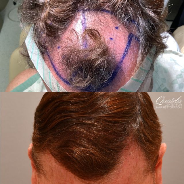 FUT hair surgery by Dr. Quatela! Amazing 3,200 graft transplant to fill in the large bald spot for this patient. Make sure you swipe through to see it from every angle!

#hairtransplant #hairsurgery #hairtransplantsurgery #hairrestoration #hairloss #hairlosstreatment #baldspot
