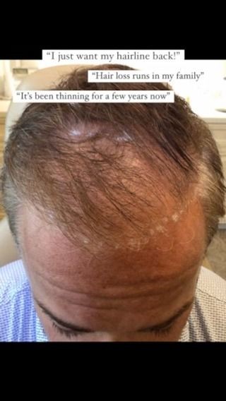 One year post hair transplant with Dr. Quatela

2,200 grafts 

FUT Method 

#hairtransplant #hairtransplantsurgery #hairsurgery #hairloss #hairlosstreatment #hairsurgeon #prpforhairloss #hairtransplantation