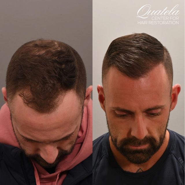 Non-Surgical Treatment: Nutrafol, Minoxidil, 82F and Zenagen shampoo and hair treatment

Surgical Treatment: 2,200 graft hair transplant using the FUE/Scarless technique 

5 month results which will only get better!

#hairloss #medicationforhairloss #nutrafol #zenagen #hairrestoration #hairrestorationspecialist #hairsurgeon #hairtransplant #hairrochester #hairtransplantrochester #rochesterhairrestoration