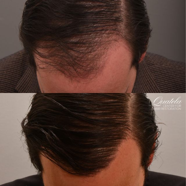 A dense, full head of hair thanks to PRP, Zenagen Hair Care and a Surgical Hair Transplant! A holistic plan by @drheatherlee 

A comprehensive approach is crucial to hair growth. There is no one size fits all solution. Some patients aren’t ready for transplant and may benefit from medication alone, others need a transplant, others won’t respond to certain topicals and will respond better to others. 

THAT is why you need a team that understands the root cause of hair loss! Schedule your consultation today for a thorough hair assessment.

#hairloss #hairlosstreatment #hairlosshelp #hairlosssolutions #hairtransplant #hairgrowth #hairgrowthtips #hairgrowthjourney