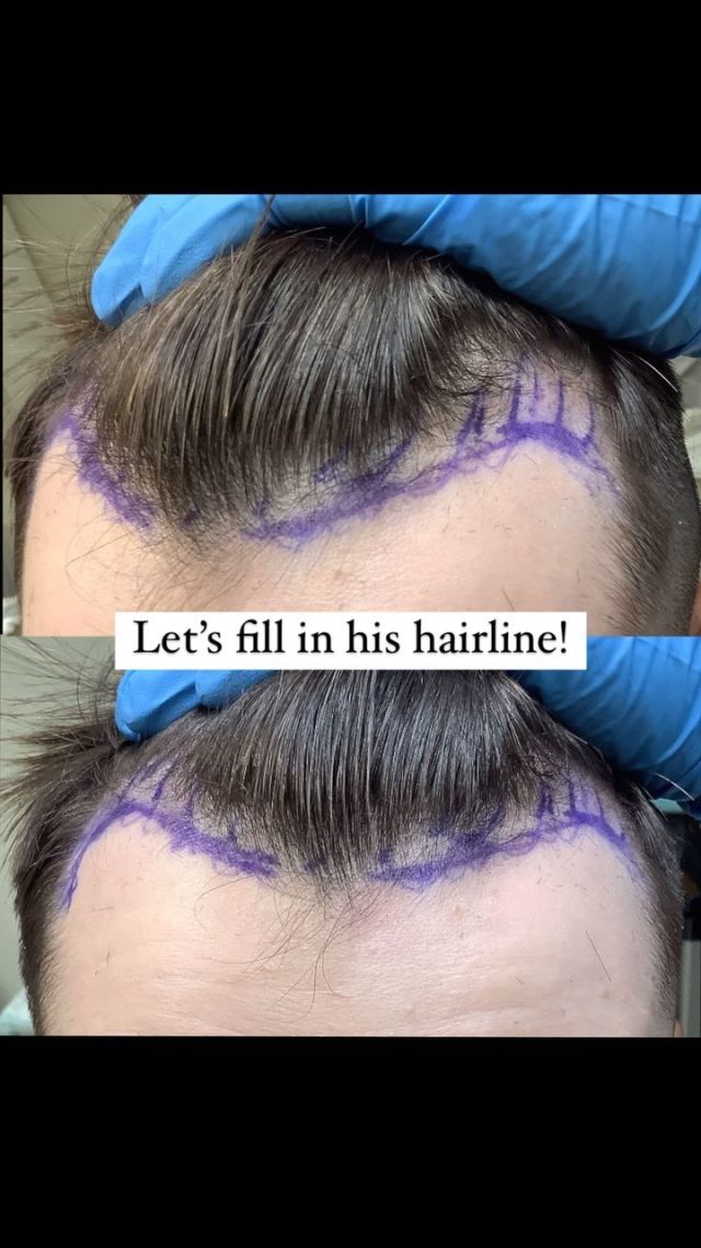 Wait until the end to see the half way point- full hair transplant results take about 1 year to truly appreciate!

FUE Hair Transplant
1,800 grafts
@drheatherlee 

#hairtransplant #hairtransplantsurgery #hairloss #hairsurgery #hairlosstreatment #hairsurgeon #prpforhairloss #hairrestoration #hairtransplantation