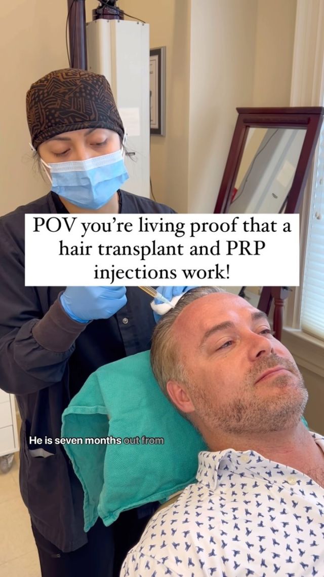 Not only does it work… it looks natural!

PRP can increase the graft rate of transplanted follicles while also thickening the existing hair follicles. We do PRP for all transplant patients the day of surgery, 3 months, 6 months and 12 months post-op. 

This patients procedure:
Technique: FUT hair transplant 
Surgeon: Dr. Vito Quatela 
Grafts: 1,900
Post-Op: 7 months 

#hairtransplant #hairtransplantsurgery #hairloss #hairsurgery #hairlosstreatment #prpforhairloss #prpforhairgrowth #plateletrichplasma #prphairrestoration