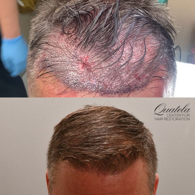 16 months out from a hair transplant with @drheatherlee 

Technique: FUE
Grafts: 2,300

The first image shows the grafts immediately after the transplant. You can see densely packed they are to create a natural result.

Schedule your consult today!

#hairtransplant #hairtransplantsurgery #hairtransplantation #hairrestoration #hairsurgery #bald #balding #hairloss #hairlosstreatment