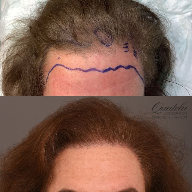 “My hairdresser of 30 years can’t believe how much hair I have!” 

9 months out from a hair transplant with @dralexmontague to completely rebuild her hairline. 

She had played around with the idea of a forehead lowering procedure, and instead chose a hair transplant to restore her hairline and in turn shorten her forehead. Make sure you check out the last photo to really see the change in where her hairline starts. 

At just 9 months out she is not yet at a full result. We are also doing PRP injections to make that hair as healthy and strong as possible. 

Check back for her 1 year results in January! 

#femalehairloss #femalehairtransplant #femalehairtransplantbeforeandafter #hairtransplant #foreheadreduction #hairlinerestoration #hairlinetransplant